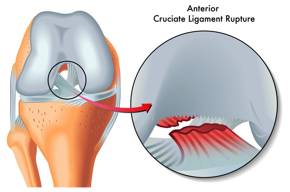 Anterior cruciate rupture illustration