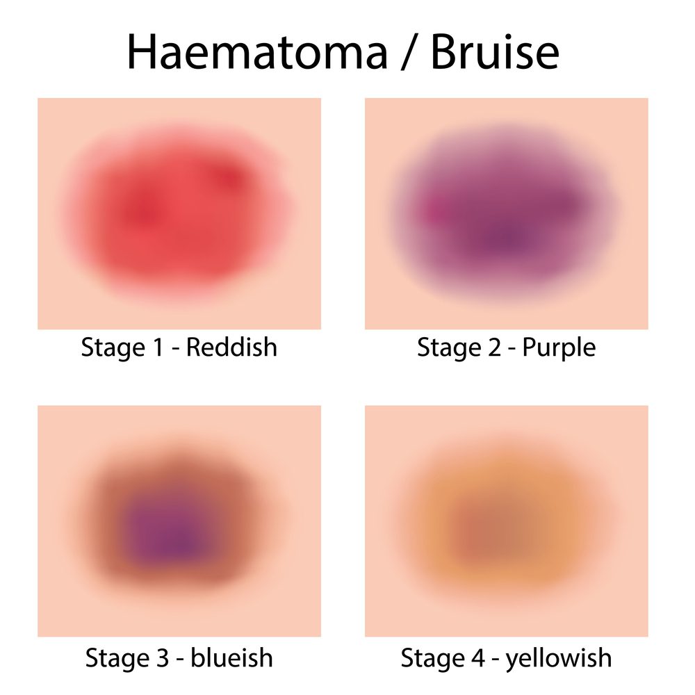 Illustration with varying hematoma