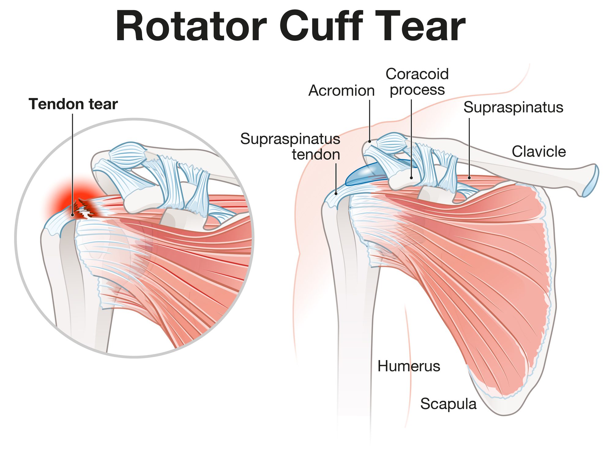 Illustration showing rotator cuff tear shoulder