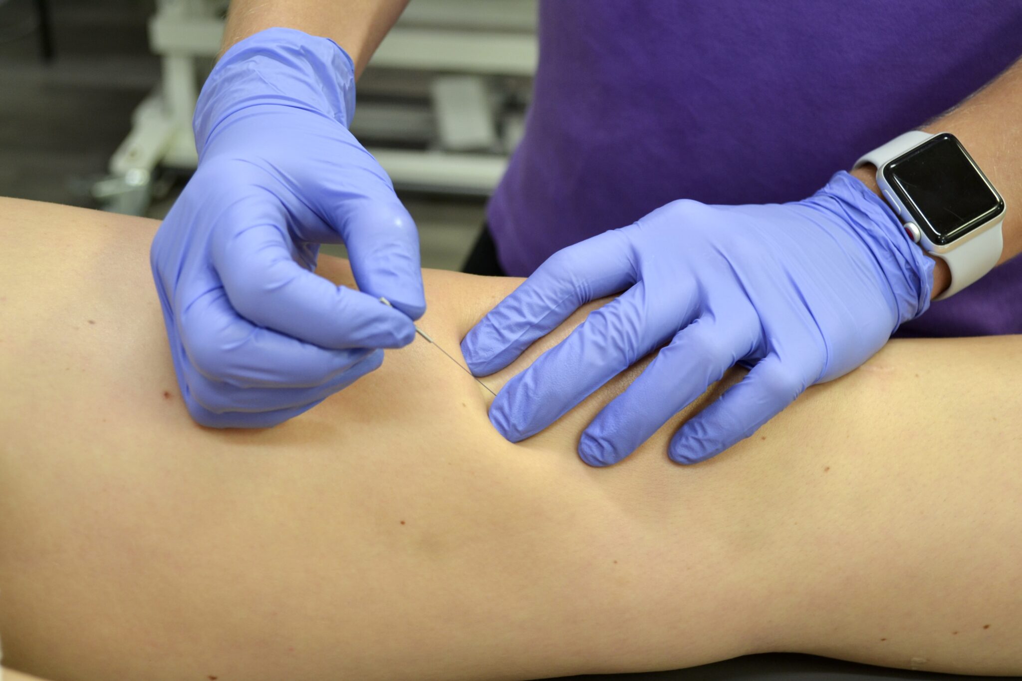What Conditions Does Dry Needling Treat?