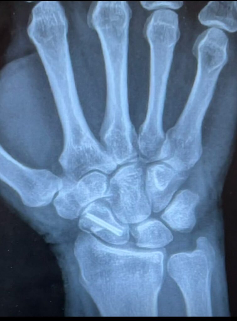 Stuey hand/wrist xray