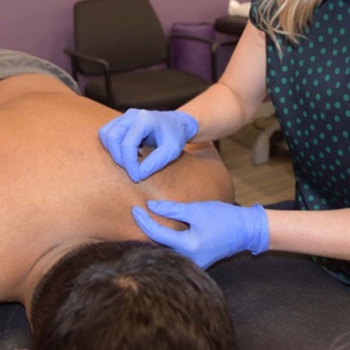 trigger-point-dry-needling-Impact-Physical-Therapy-Sport-Recovery-Champaign-Hinsdale-Chicago-Naperville-Oak-Lawn-Orland-Park-IL